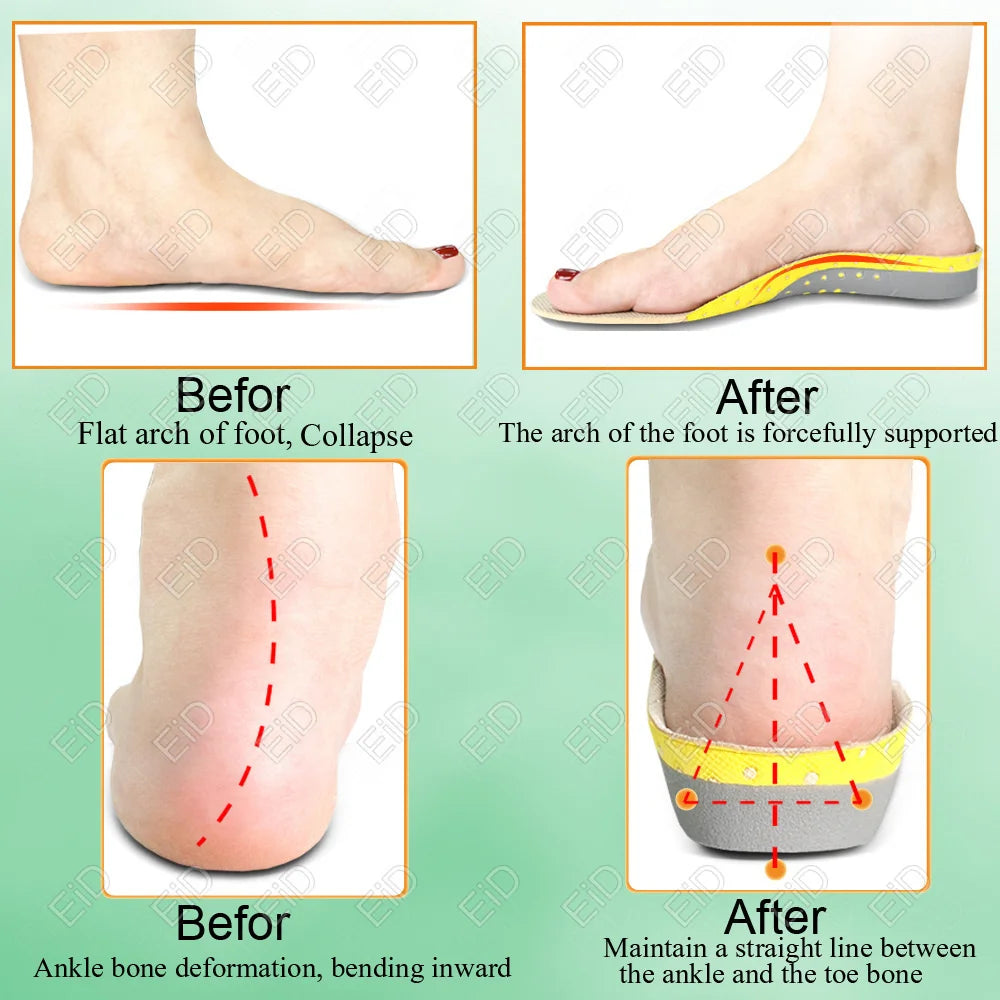 Premium Orthotic Gel Insoles for Flat Foot Support and Plantar Fasciitis Relief - Unisex Arch Support Shoe Inserts